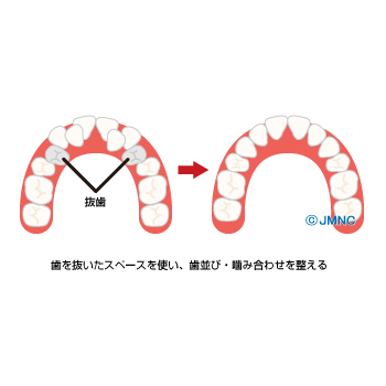 矯正で抜歯が必要になる理由