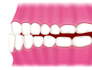 受け口 (反対咬合)