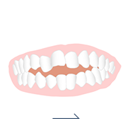 前歯で噛めない 開咬